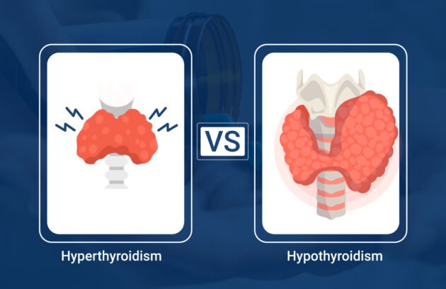 Hypothyroidism vs Hyperthyroidism
