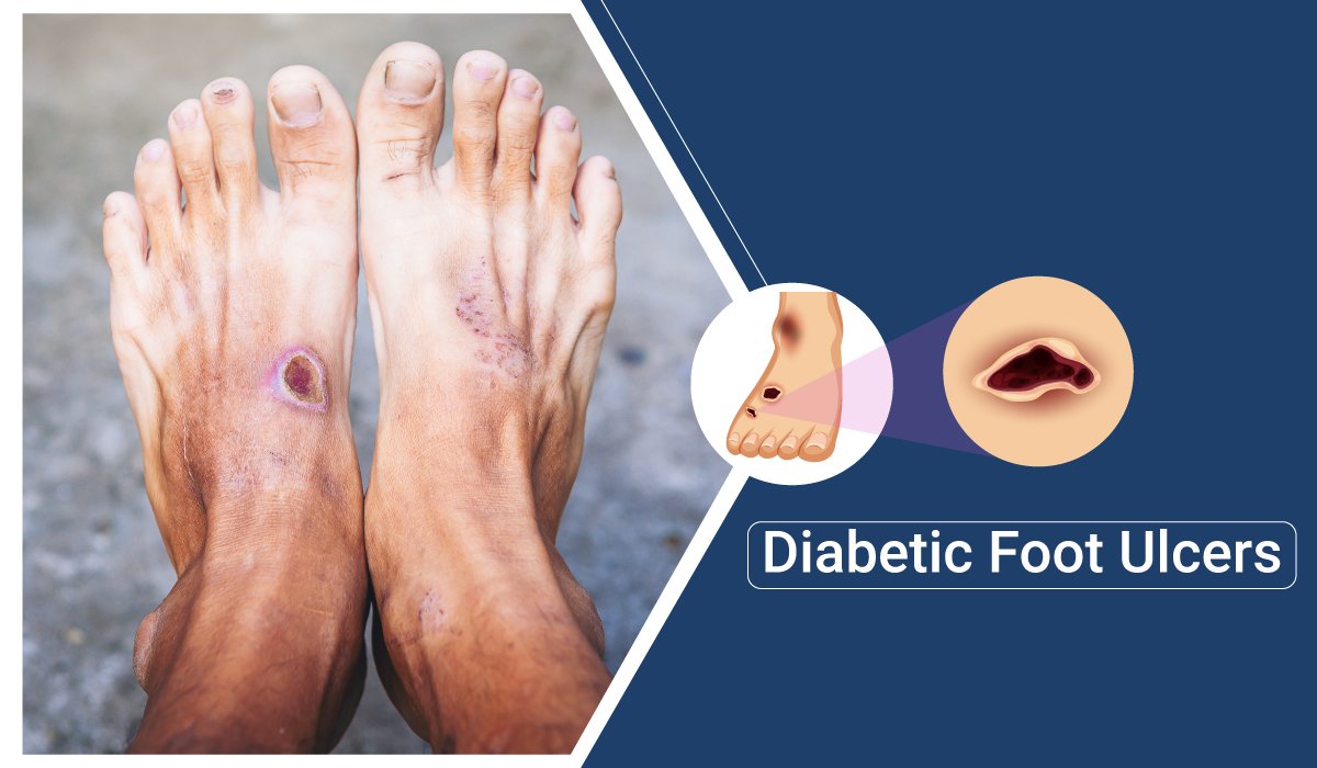 Diabetic Foot Ulcer Model | Diabetic Foot Ulcer Simulator