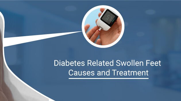 Diabetes-Related-Swollen-Feet-Causes-Treatment