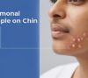 Hormonal Pimple on Chin