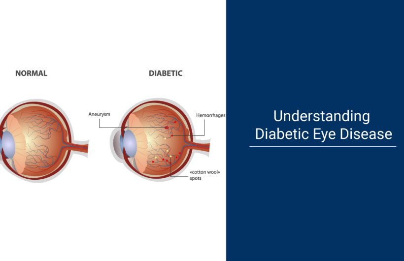 Diabetic Eye Disease