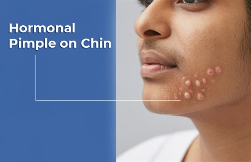 Hormonal Pimple on Chin