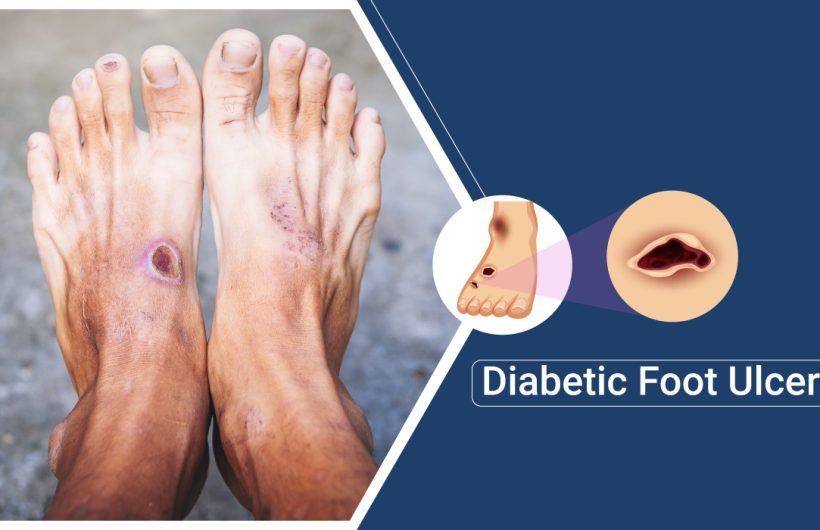 diabetic foot ulcer